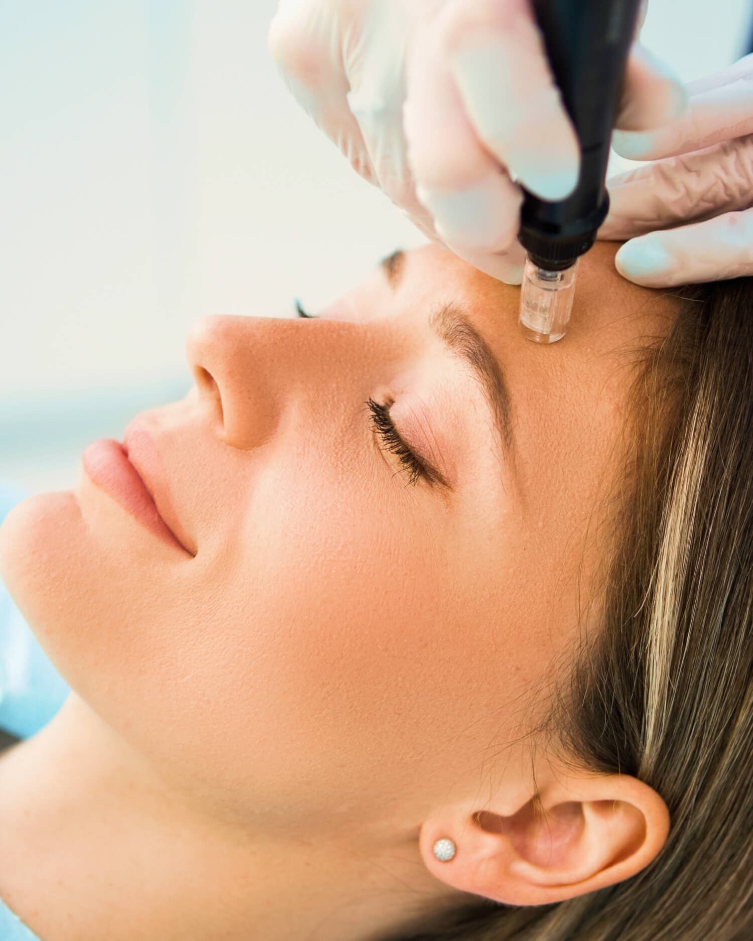 Microneedling-Treatment_1500x1875
